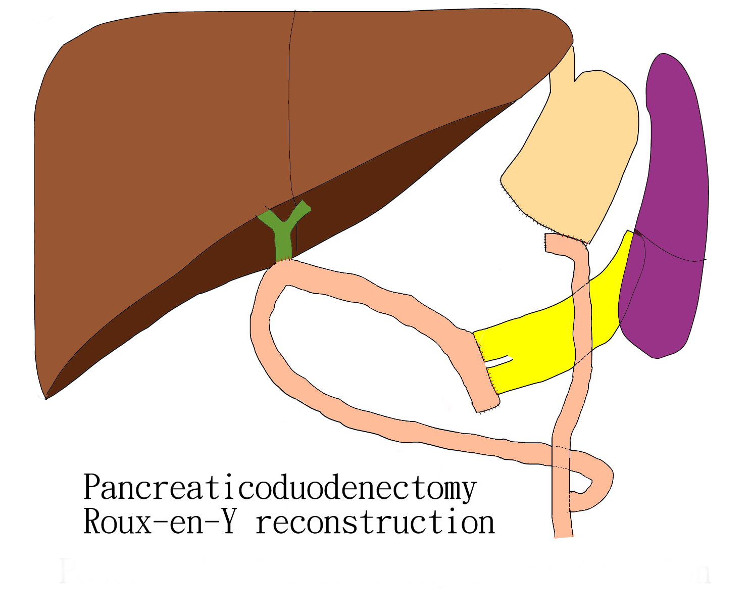 pancreaticoduodenectomy-1
